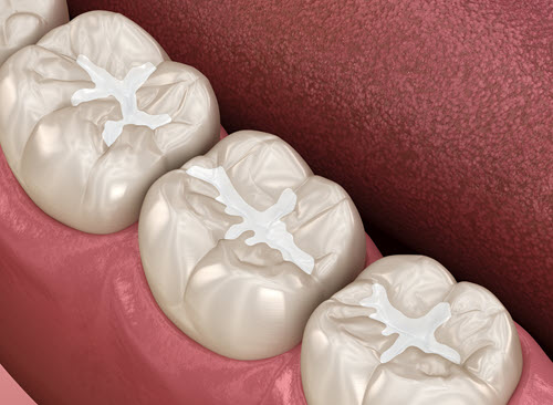 Composite Fillings