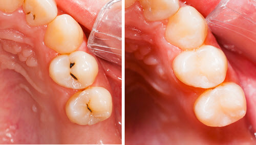 Composite Fillings