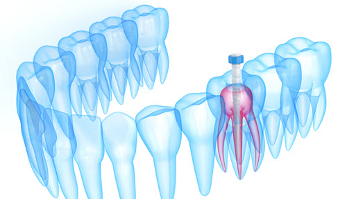 Root Canal