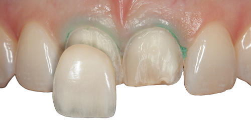 Dental Veneers at Advanced Dental Partners Harrisburg PA