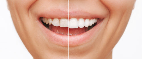 Dental Veneers at Advanced Dental Partners Harrisburg PA