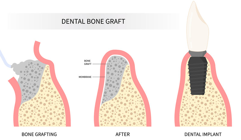 bone graft