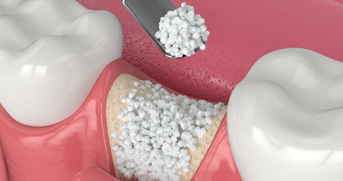 bone graft