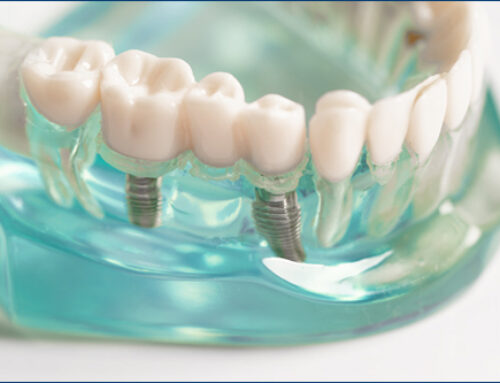 Dental Implants 101: Everything You Need to Know Before Getting Them