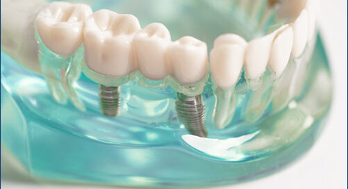 Dental Implants