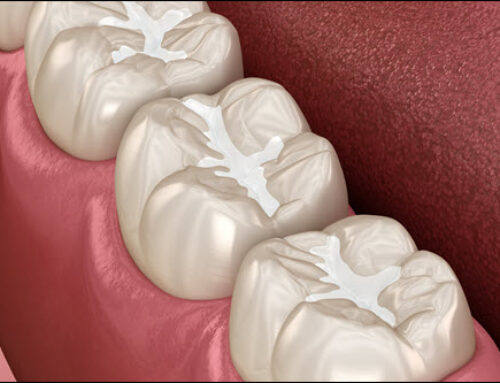 The Benefits of Dental Sealants: Protecting Your Teeth from Decay