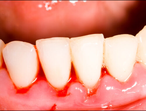 Recognizing and Preventing Gingivitis for a Lifelong Healthy Smile