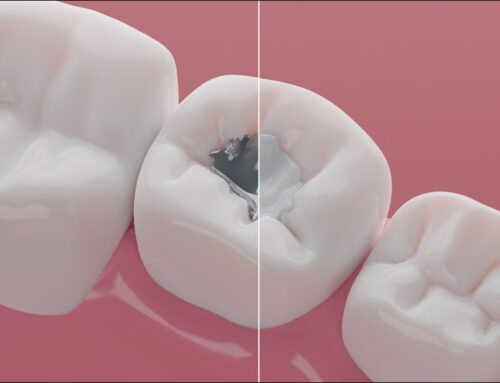 Composite Dental Fillings: Benefits and Procedure
