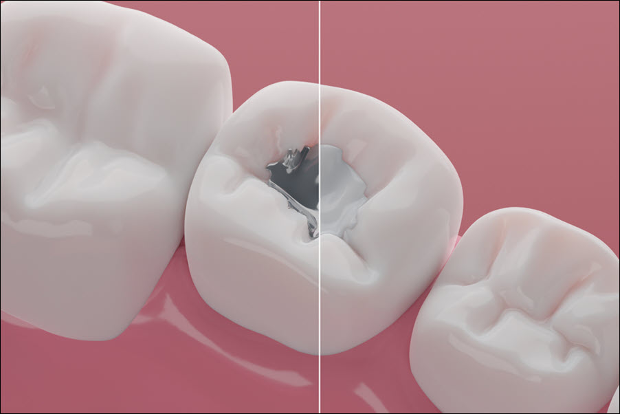 Composite Fillings