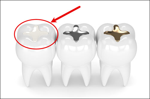 Composite Fillings