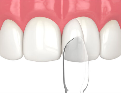 The Benefits of Dental Bonding