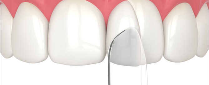 Dental Bonding