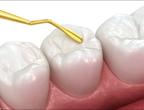 Dental Sealants: Protect and Preserve Healthy Teeth