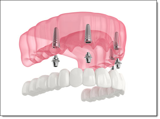 Dentures